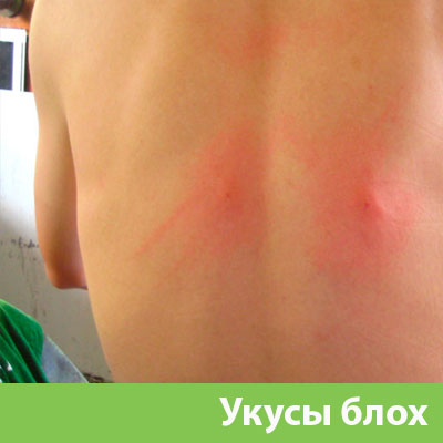 Укусы блох в Череповце