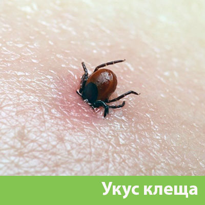 Укус клеща в Череповце