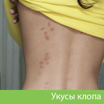 Профессиональное уничтожение клопов в Череповце